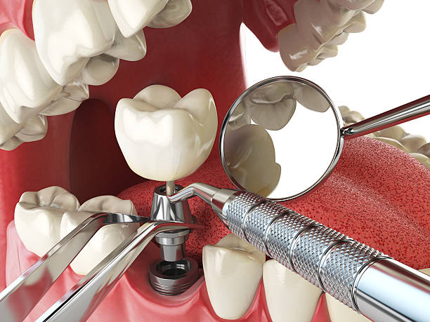 Best Emergency Root Canal Therapy in Pelahatchie, MS
